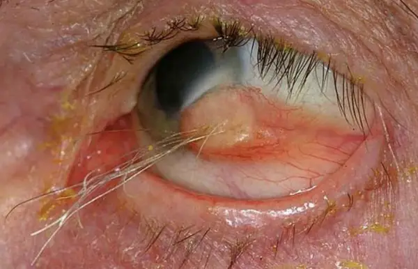 Eye-Catching Anomalies: Hair-Growing Tumors and Their Unlikely Location