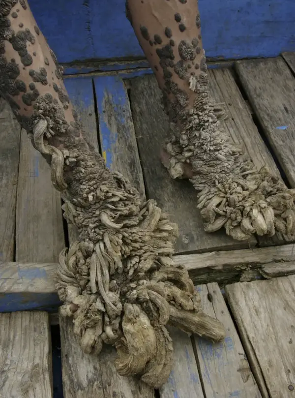 human body Bark-Like Growths: Confronting the Reality of Epidermodysplasia Verruciformis