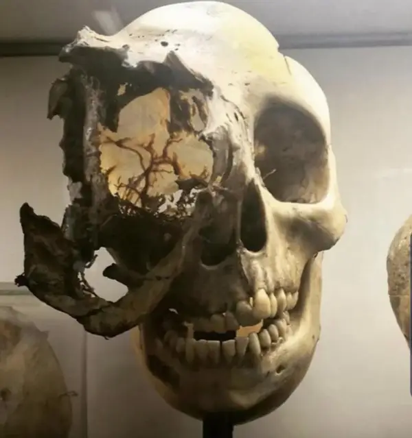 Skulls and Bone Cancer: A Terrifying Alliance