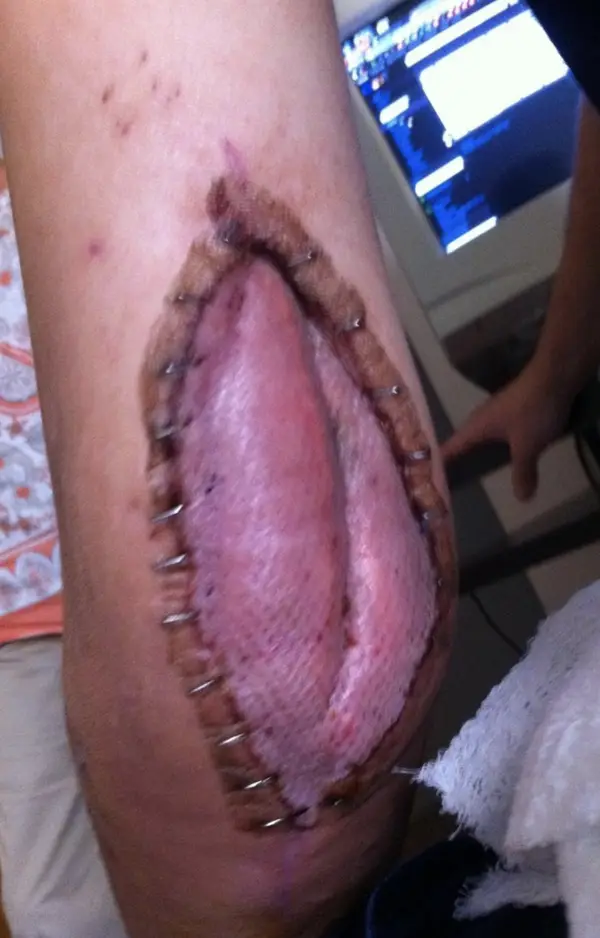Compartment Syndrome Unveiled: An Open Look at Pressure Relief