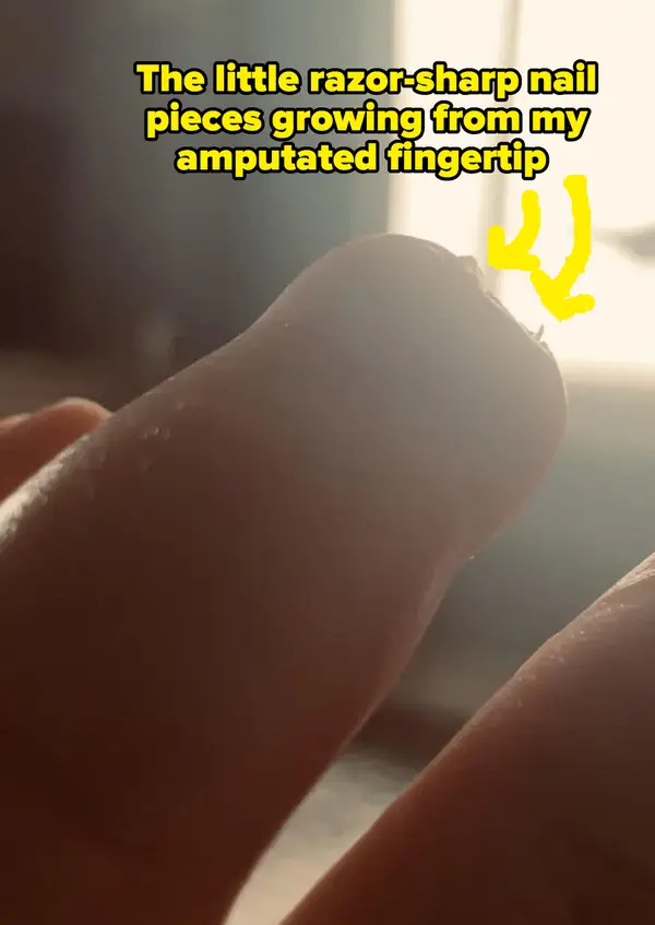 Amputation Anomalies: Navigating the Nooks of Nail Beds