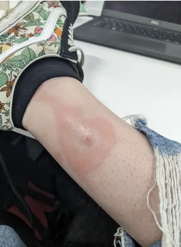 human body Lyme Disease: A Tick-Borne Tragedy Captured