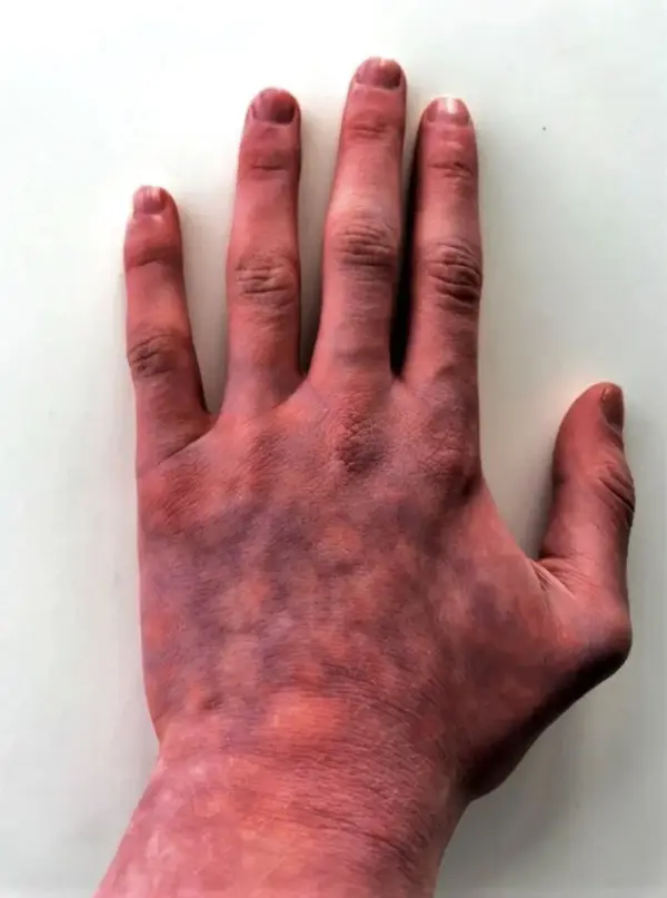 Cold Consequences: Exploring the Effects of Cutis Marmorata