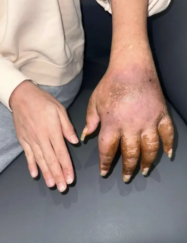 human body The Complexities of Pain: Visualizing Complex Regional Pain Syndrome