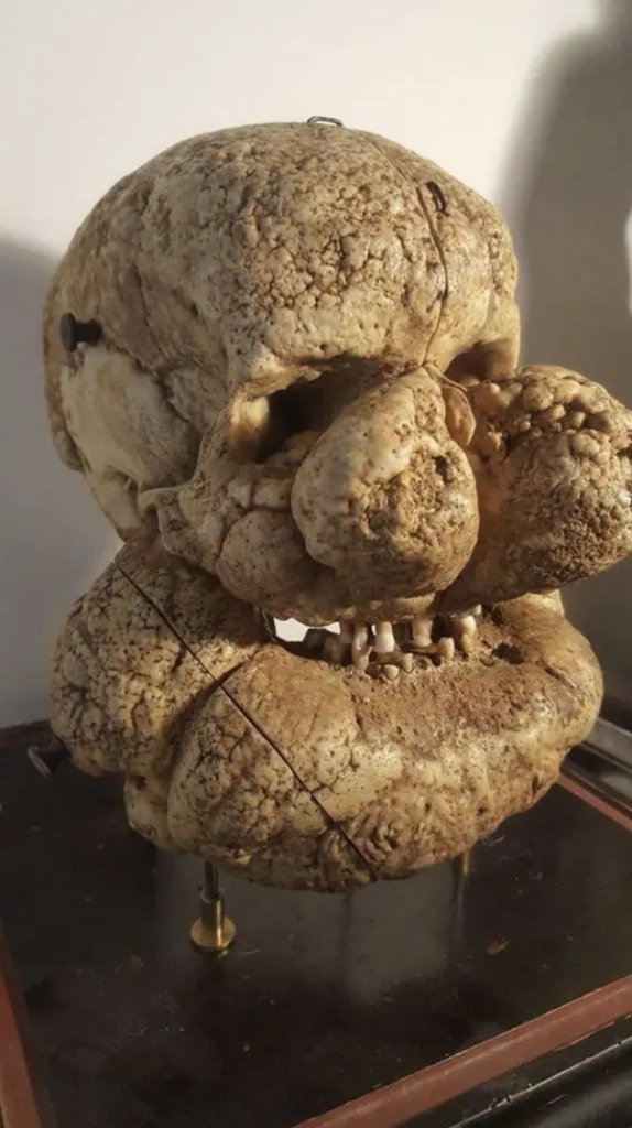 Skulls and Syndrome: The Distorted Reality of Proteus Syndrome