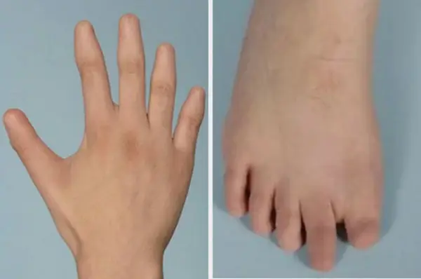 human body Navigating Naillessness: Understanding Anonychia Congenita