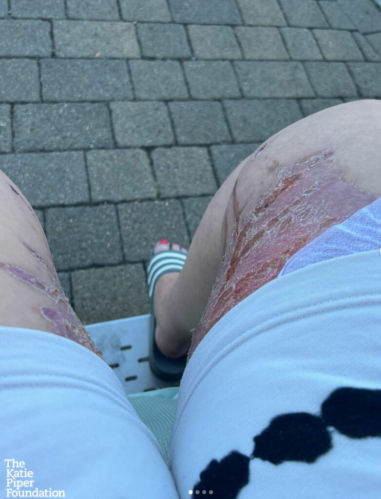 Legs with burns, toes with polish, against a gray stone background.