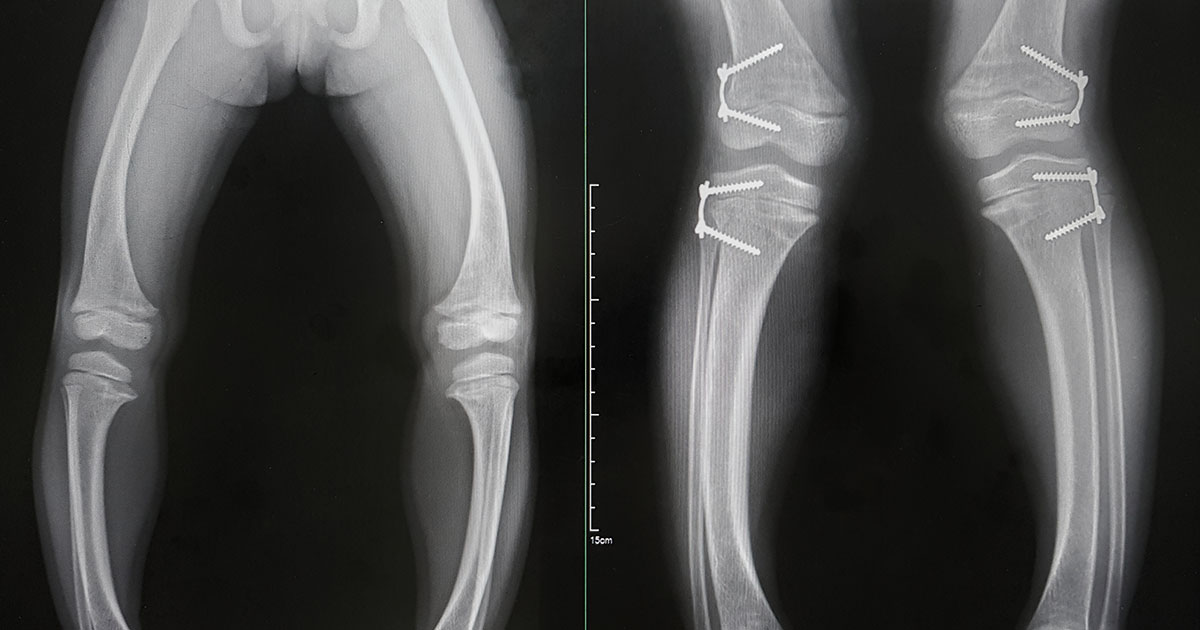 The Connection Between Arthritis and Vitamin D