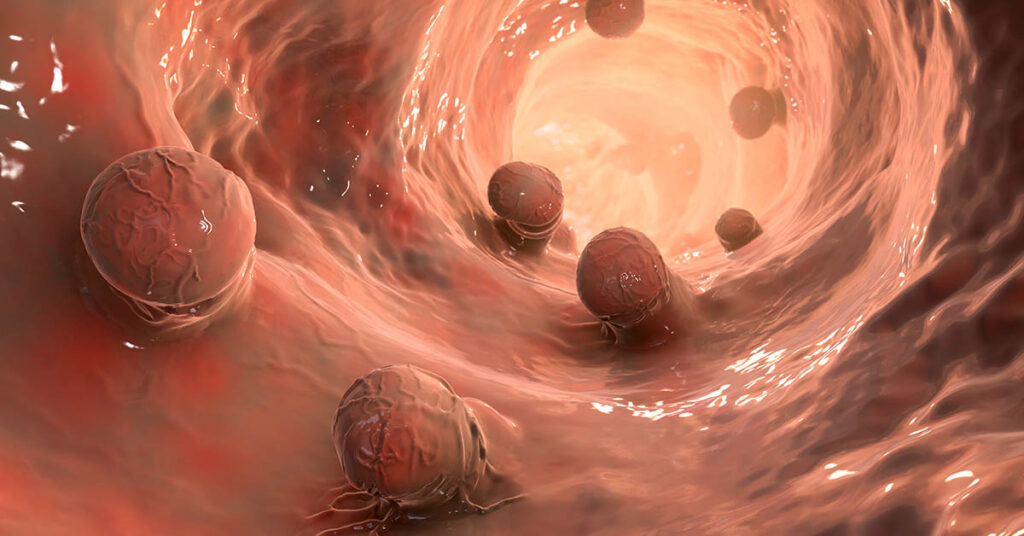 8 Symptoms of Colon Polyps and 4 Signs They May Be Cancerous - Featured image