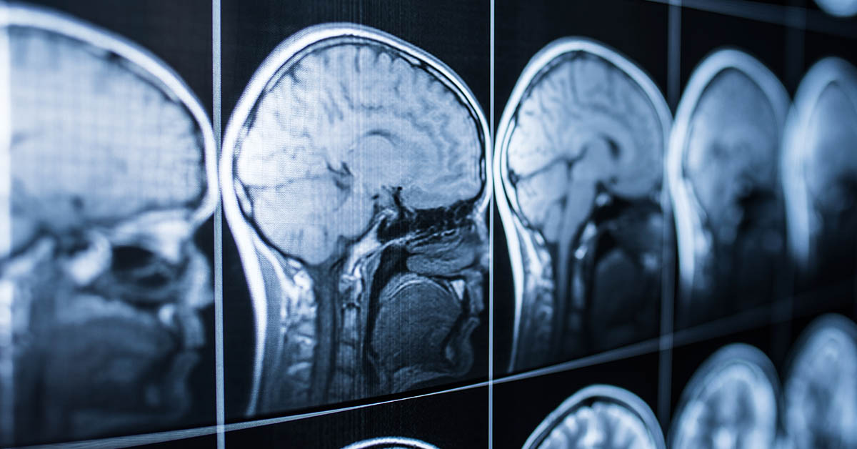 Doctors Thought Woman Had Cancer, But It Was Actually a Brain-Eating Amoeba