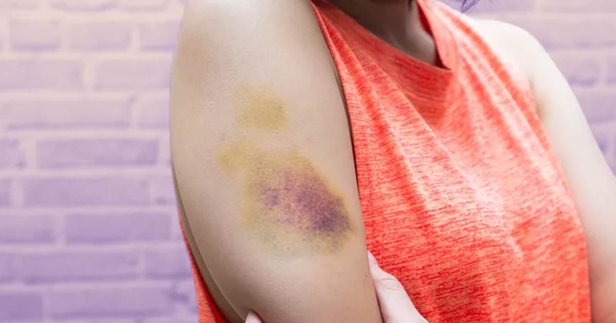 10 Reasons Why You’re Bruising Easily