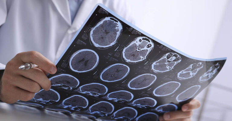 Is a Common Virus Causing Multiple Sclerosis? - Featured image
