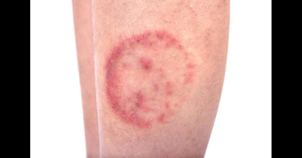Closeup of ringworm infection or Tinea corporis on skin isolated on white background, Dermatophytosis on skin isolated