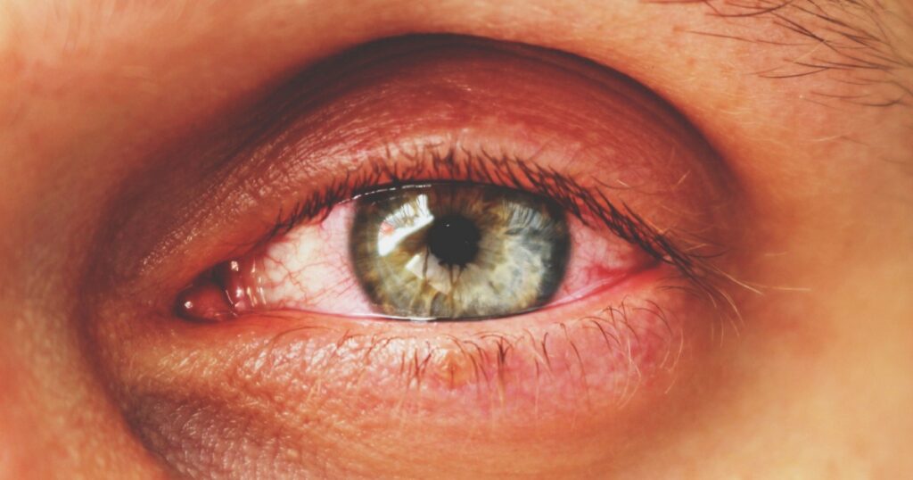 red eye of a patient with human conjunctivitis, retro toned