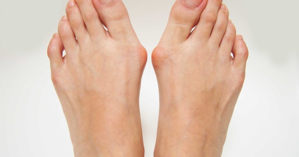 Varus valgus and Hallux valgus, bunion on white background.