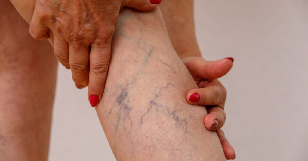 Elderly woman in white panties shows cellulite and varicose veins on a light isolated background. Concept for medicine and cosmetology.