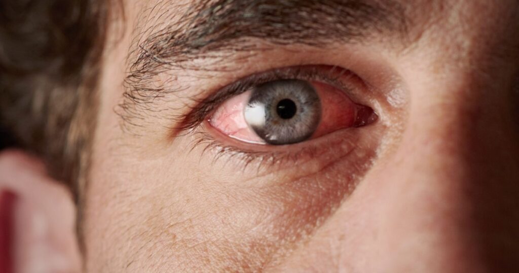 Closeup of irritated red bloodshot eye