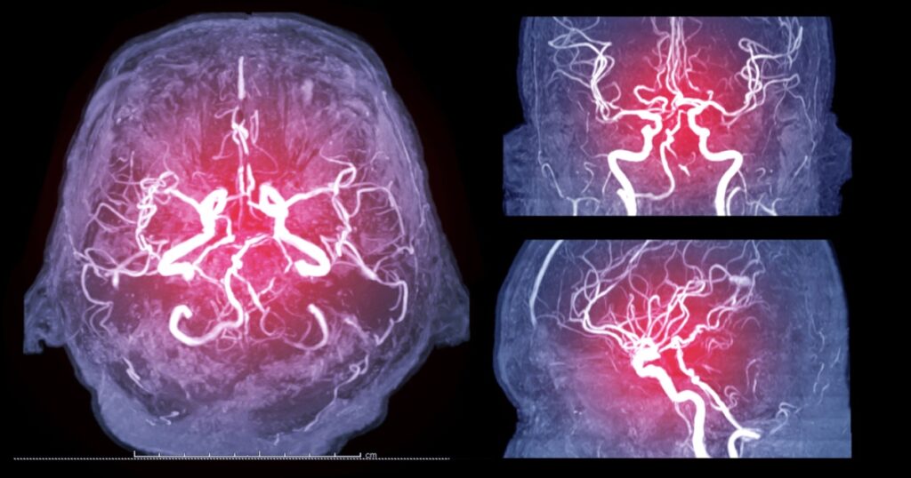 Collection of MRA brain or Magnetic resonance angiography image ( MRA ) of cerebral artery in the brain for detect stroke disease.