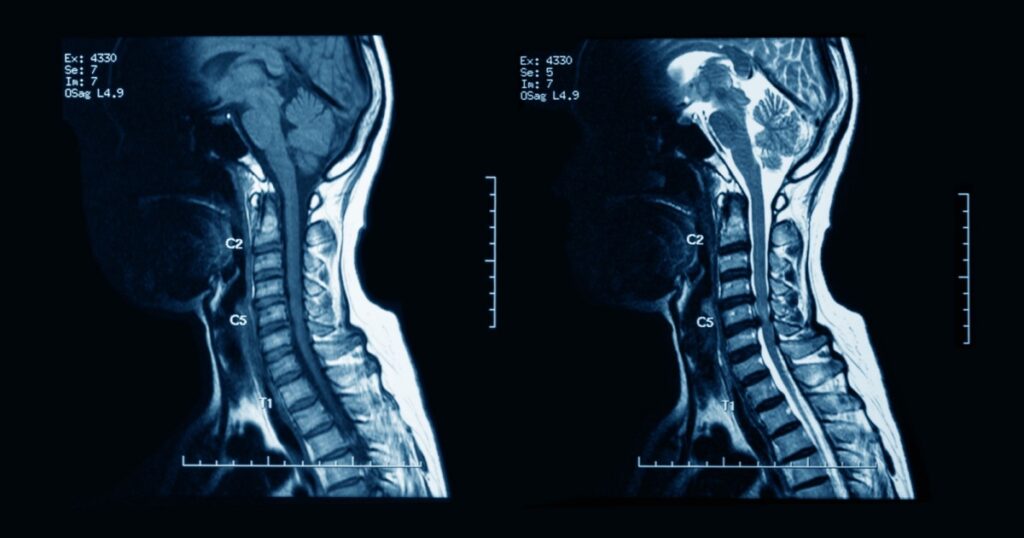 MRI scans of the cervical spine, with and without contrast media, MRI with bilateral C7 nerve root compression, Cervical spondylosis.