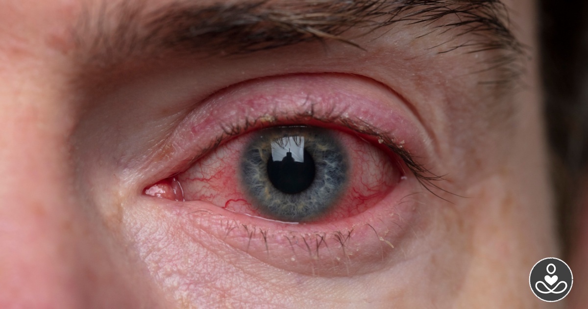 How to Help Prevent 8 Common Eye Issues
