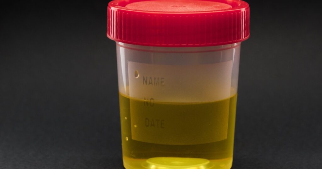 urine in a jar for analysis on a dark background