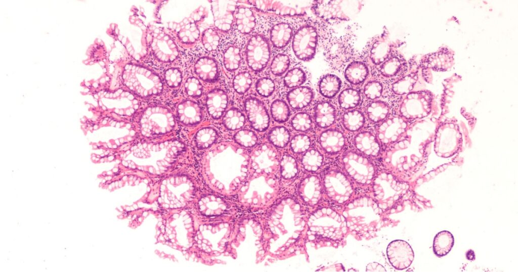 Hyperplastic colon polyps are often removed at the time of colonoscopy when screening for colon cancer. They are benign. Unlike adenomas, they are not precancerous and have no increased risk.
