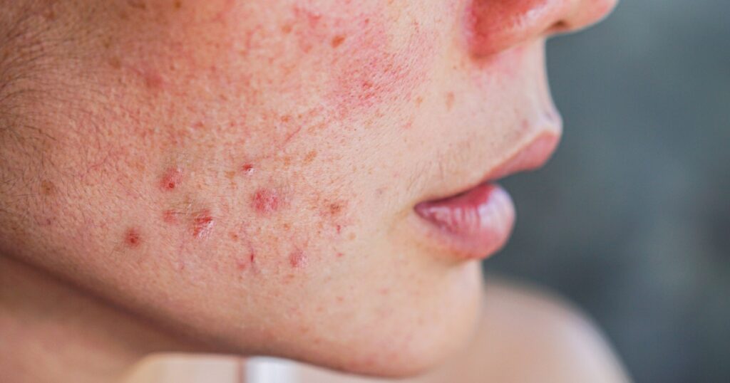 closeup acne on woman's face with