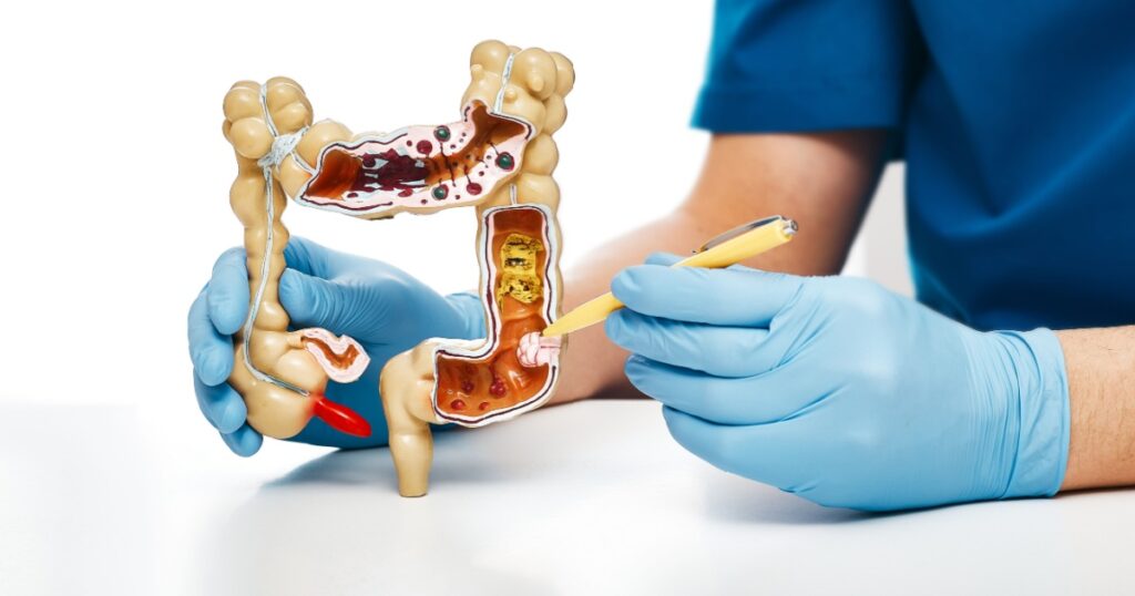 Cancer intestines. Gastroenterologist pointing pen tumor colon using an anatomical model for medical education