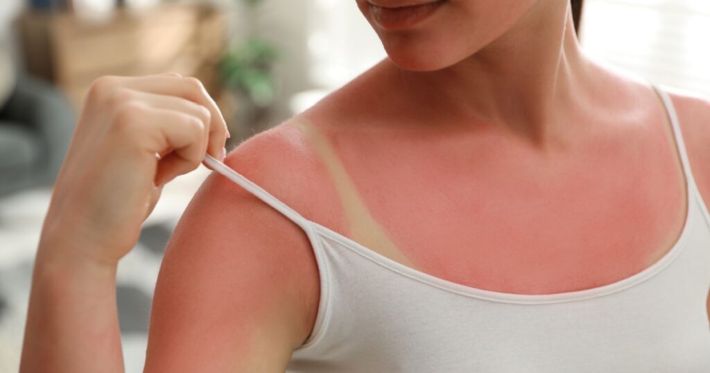 Woman with sunburned skin at home, closeup
