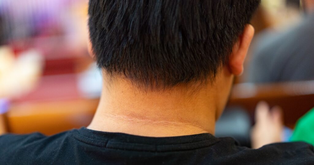 Fat man with black marks of the skin around the neck of an overweight man.One of the warning signs of diabetes. the medical health of acanthosis nigricans in a male with diabetes with a dark mark.