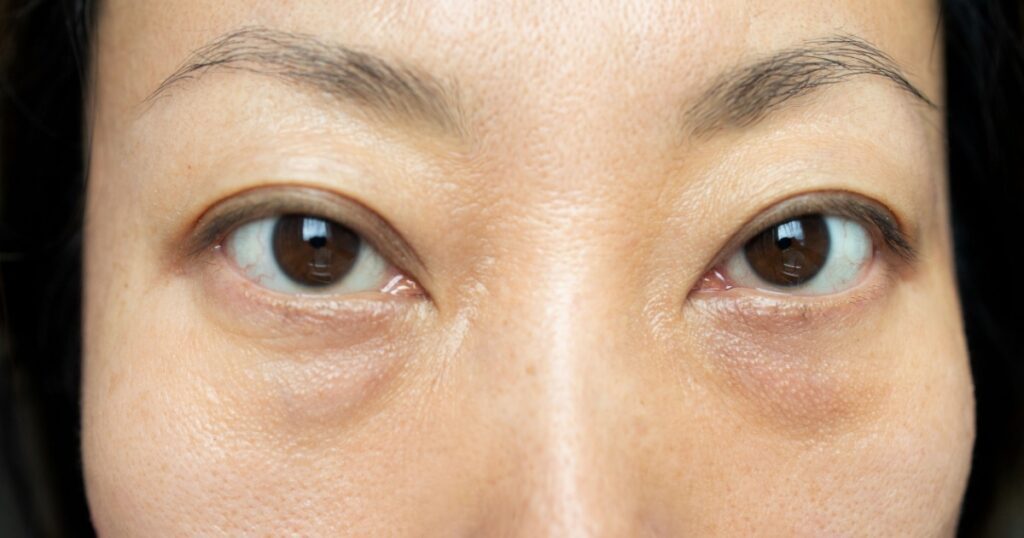 Asian woman have facial wrinkles, large bags under their eyes.