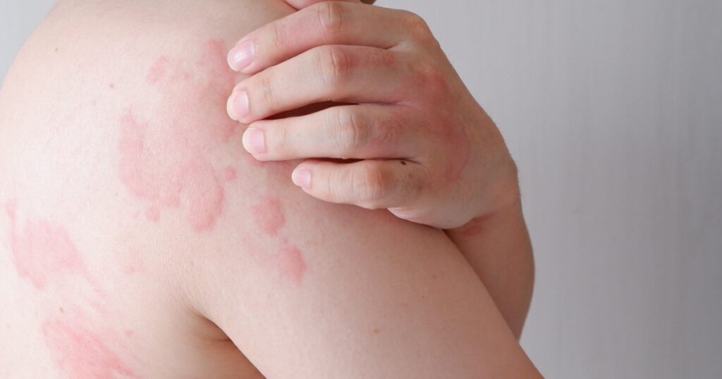 Close up image of skin texture suffering severe urticaria or hives or kaligata. Allergy symptoms.
