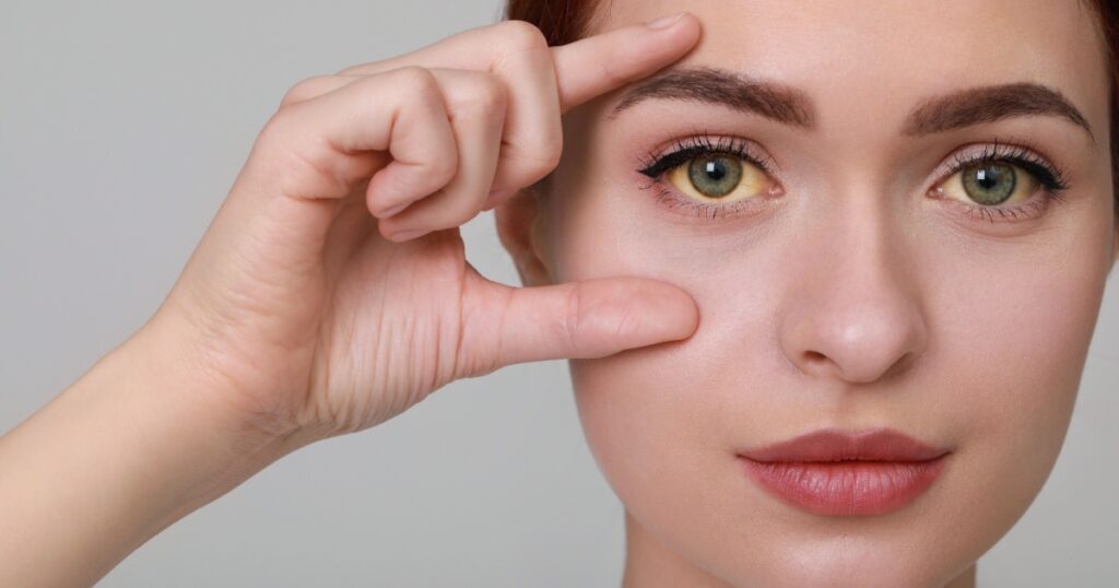 Woman with yellow eyes on light grey background. Symptom of hepatitis