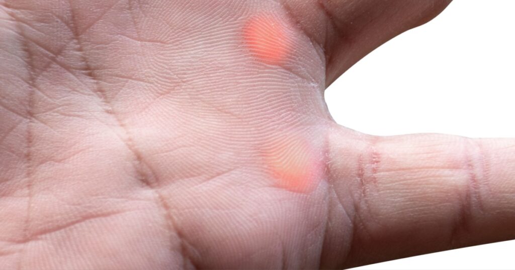 Scleroderma on palm isolated on white background with clipping path
