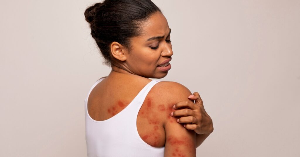 Sensitive Skin, Food allergy symptoms, Irritation. Annoyed young african american woman scratching red spots all over her body, isolated on grey studio background, copy space, back view
