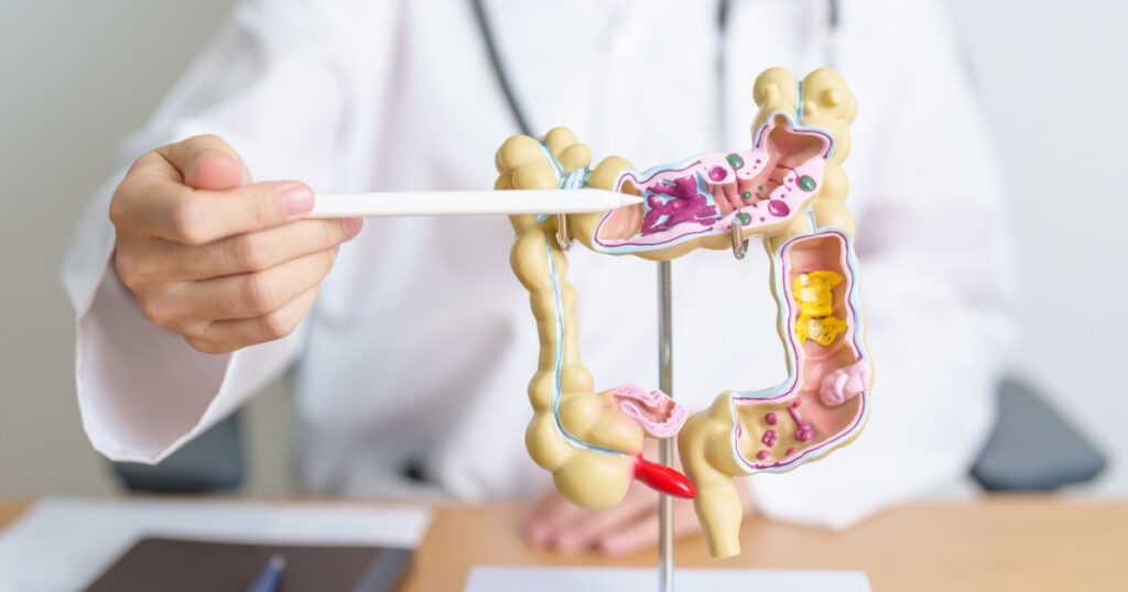 Doctor with human Colon anatomy model. Colonic disease, Large Intestine, Colorectal cancer, Ulcerative colitis, Diverticulitis, Irritable bowel syndrome, Digestive system and Health concept
