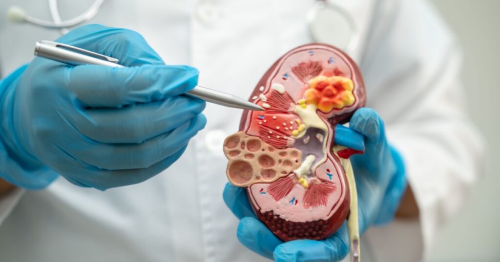 Kidney disease, Chronic kidney disease ckd, Doctor hold model to study and treat in hospital.