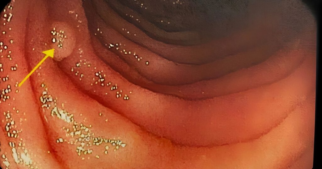 A colon polyp found in the large intestine of a person with Lynch Syndrome during a colonoscopy.