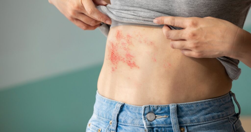 Woman with shingles on the skin she feels very painful