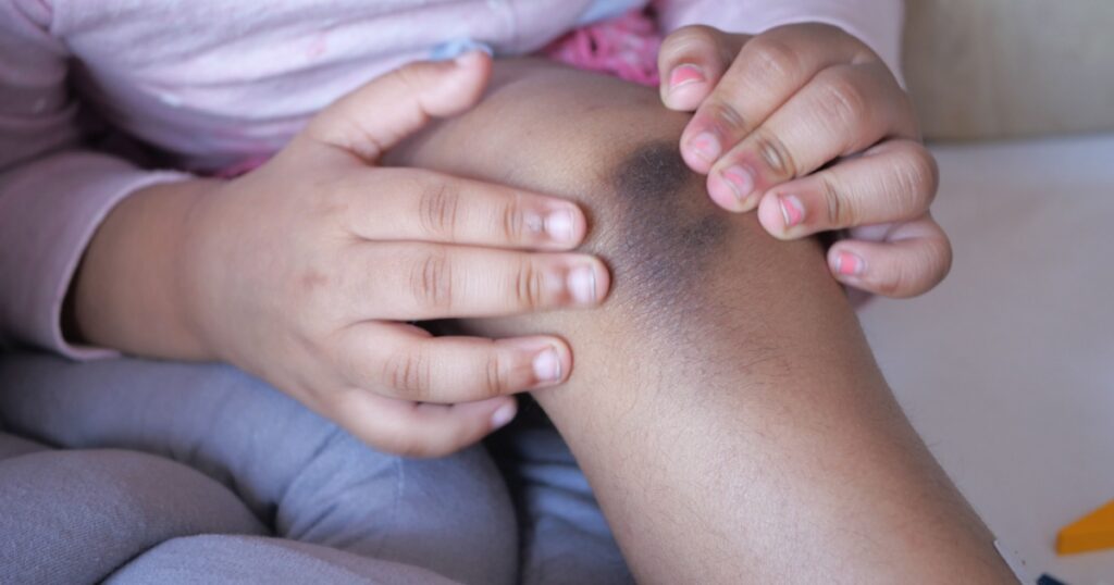 stain bruise wound on child knee.