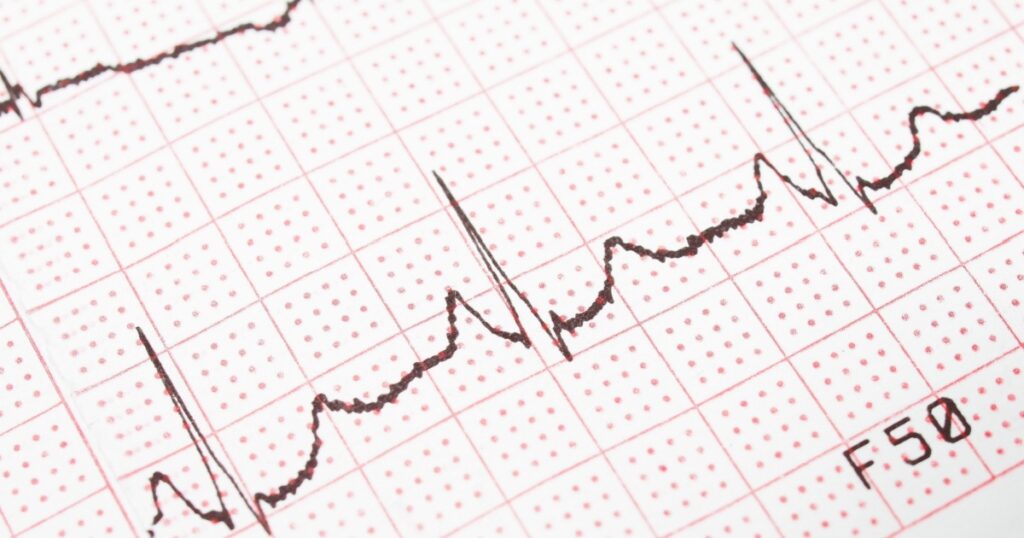Electrocardiogram, ECG printout, EKG background