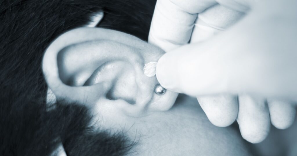Auriculartherapy oriental acupunture ear seed sticker plaster auriculatherapy treatment physiotherapy. Physiotherapist in hospital clinic,