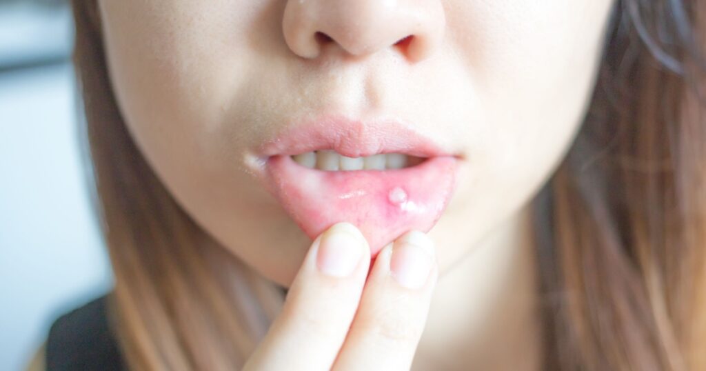 Woman with aphthae on lip.