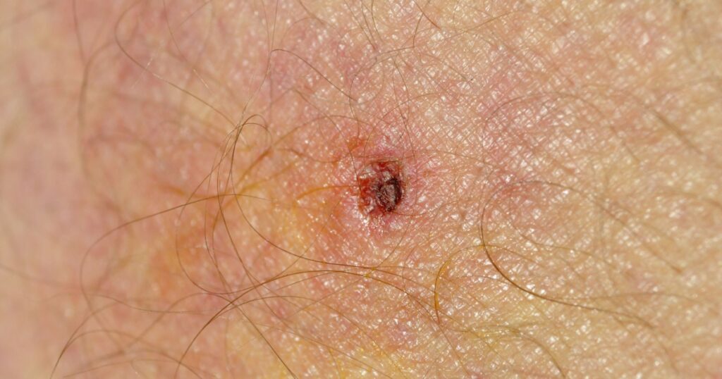 infected tick bite on thigh