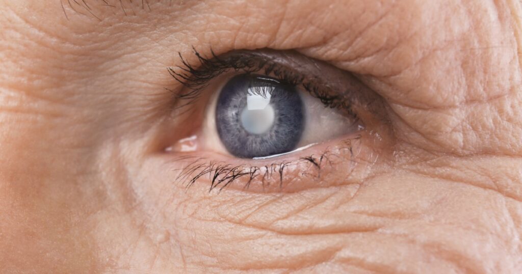 Cataract concept. Senior woman's eye, closeup