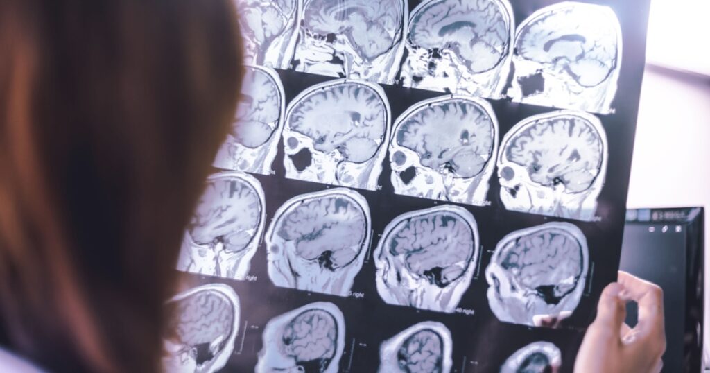 Vacular dementia MRI brain