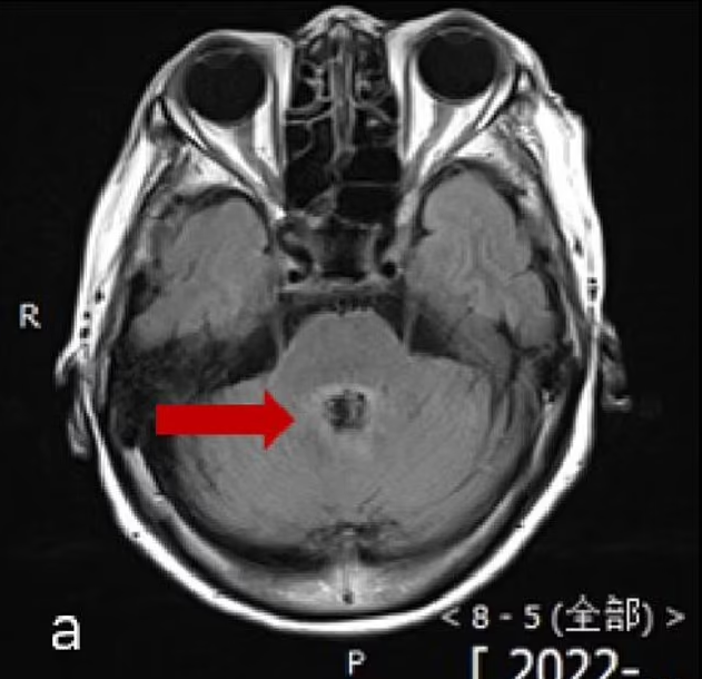 Initial Misdiagnosis: A Fatal Error Leading to Amoeba Instead