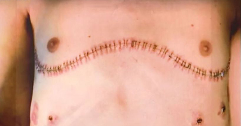 Teen With Double Lung Transplant From Vaping Warning His Peers