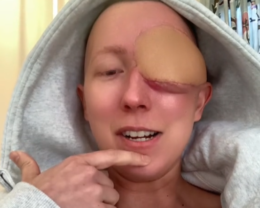 Annika, a 28-year-old woman from California, shares a harrowing tale of battling a deadly sinus cancer