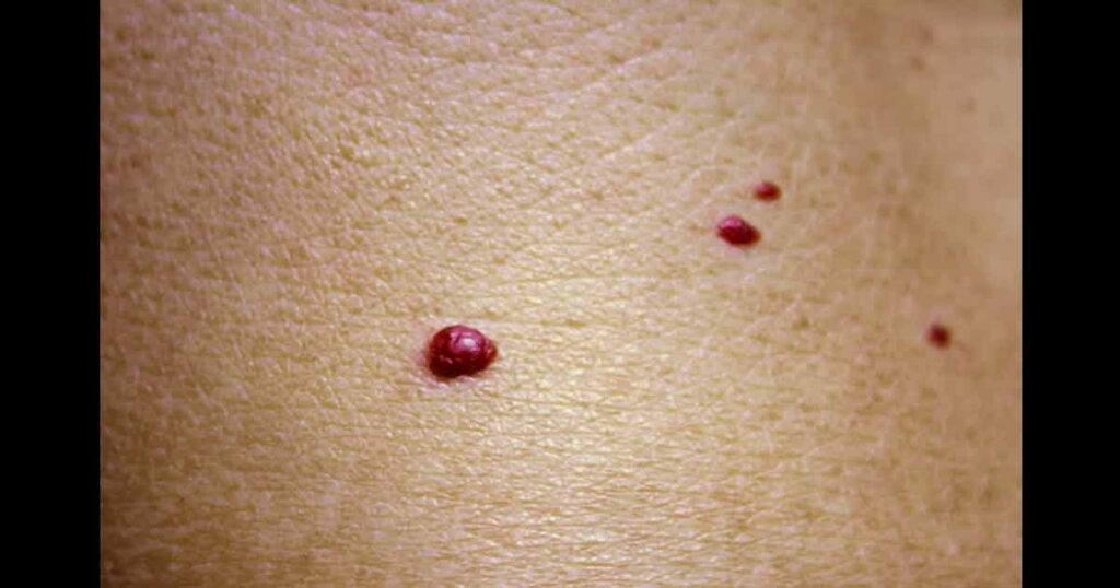 Angioma. Red birthmark on the skin surface.